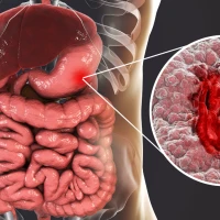 Виразка шлунка або як жити з хелікобактером?