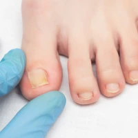 Грибок нігтів: що треба знати, щоб вилікуватись та не захворіти знову