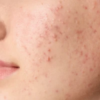 Паразитарне акне: чи можна заразитися від собаки?