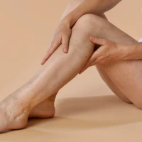 Варикозна хвороба у молодих: 6 факторів, які можуть її спровокувати