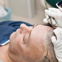 NEW! Пересадка волосся в МЦ «Оксфорд Медікал Тернопіль»