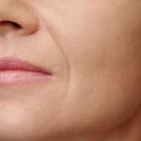 Як застосовуються філери для носогубних складок? Розповідає лікар-косметолог