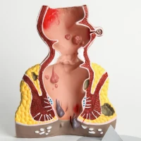 Анальна тріщина: відповіді на найчастіші питання