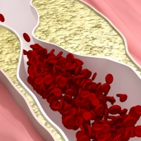 Атеросклероз: чим загрожує високий холестерин?