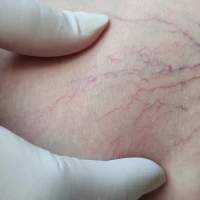 ТУРБУЄ ВАРИКОЗ? ЛІКУЄМО ВАРИКОЗ НОВІТНІМ ЛАЗЕРОМ ВСЬОГО ЗА 60 ХВ!