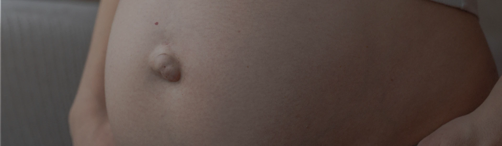 Висічення пупкової грижі