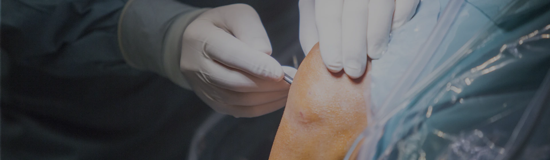 Операція при нестабільності надколінника