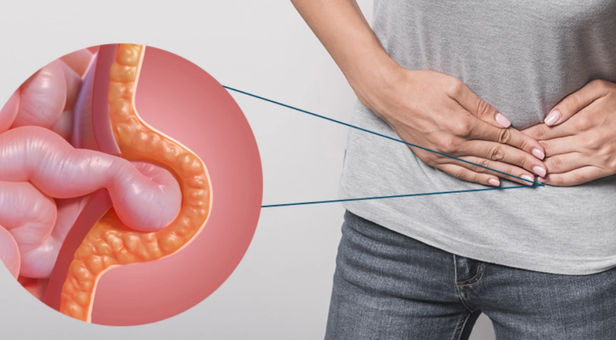 ЛАПАРОСКОПІЧНЕ ВИДАЛЕННЯ ПАХОВИХ ГРИЖ В ОКСФОРД МЕДІКАЛ ТЕРНОПІЛЬ